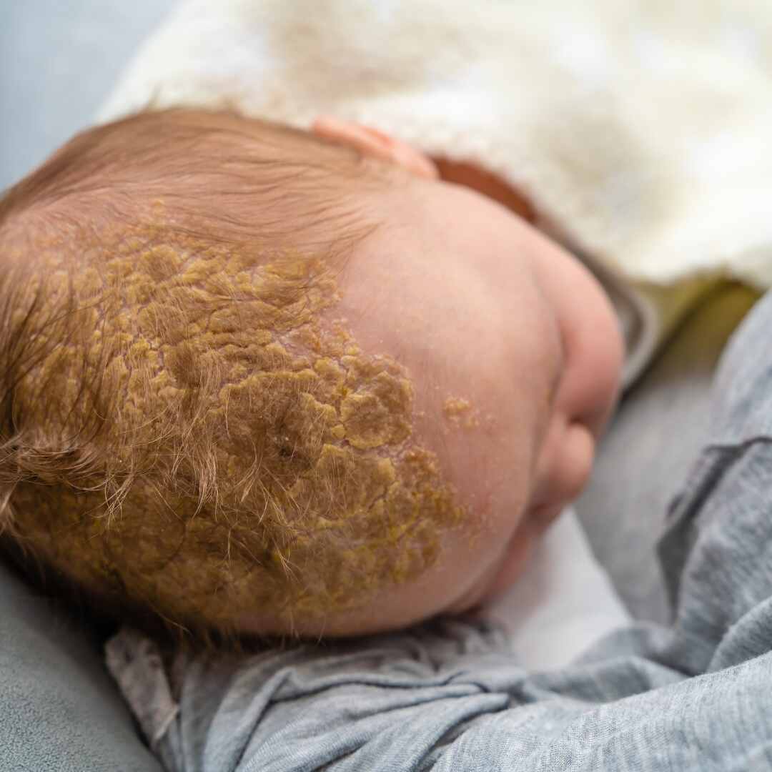 Cradle cap