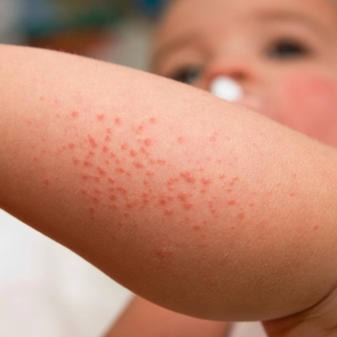 Heat Rash