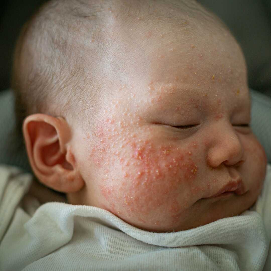 Baby acne