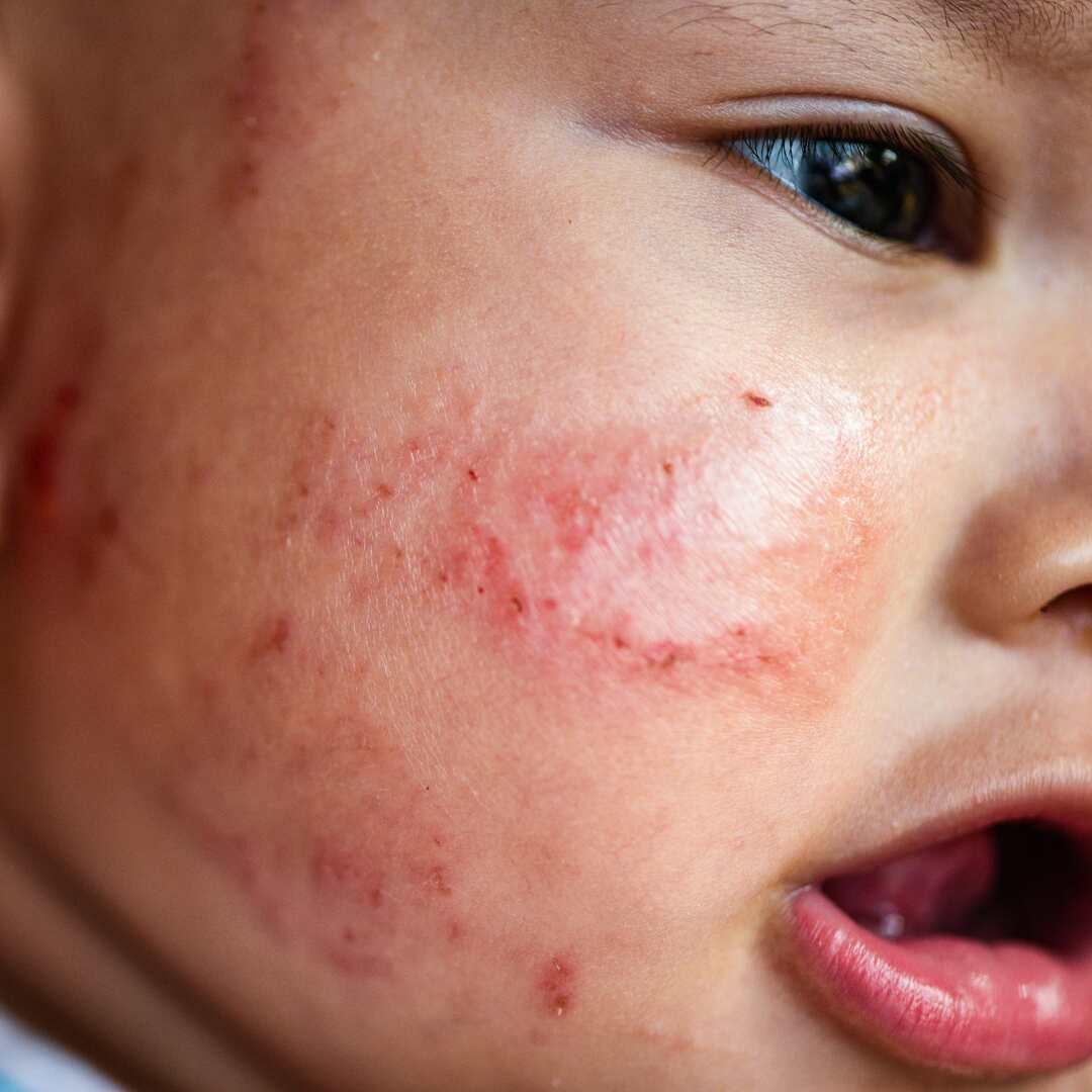 Eczema